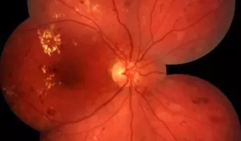 Fundus photo of a retina showing the light-sensitive tissue that lines the back of the eye