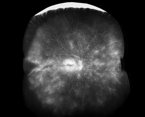 The retina